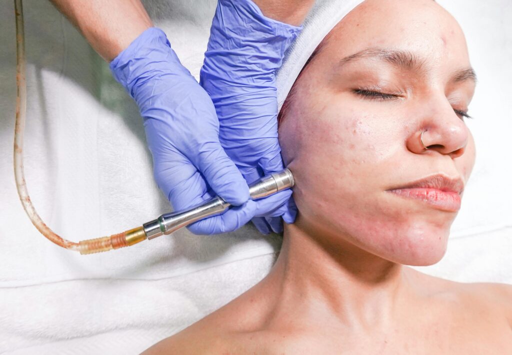 MNRF (Microneedling Radiofrequency) MNRF (Microneedling Radiofrequency)