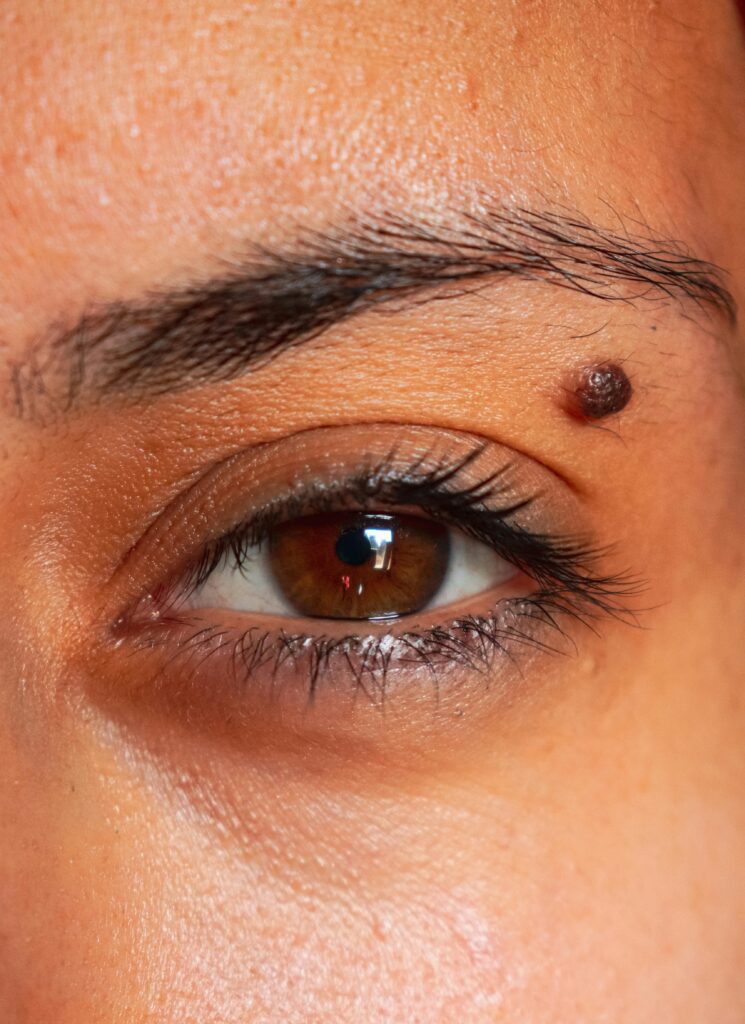Detailed close-up of a brown eye with visible mole above eyebrow.