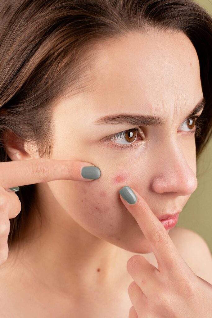 Acne Treatment in Nagarabhavi