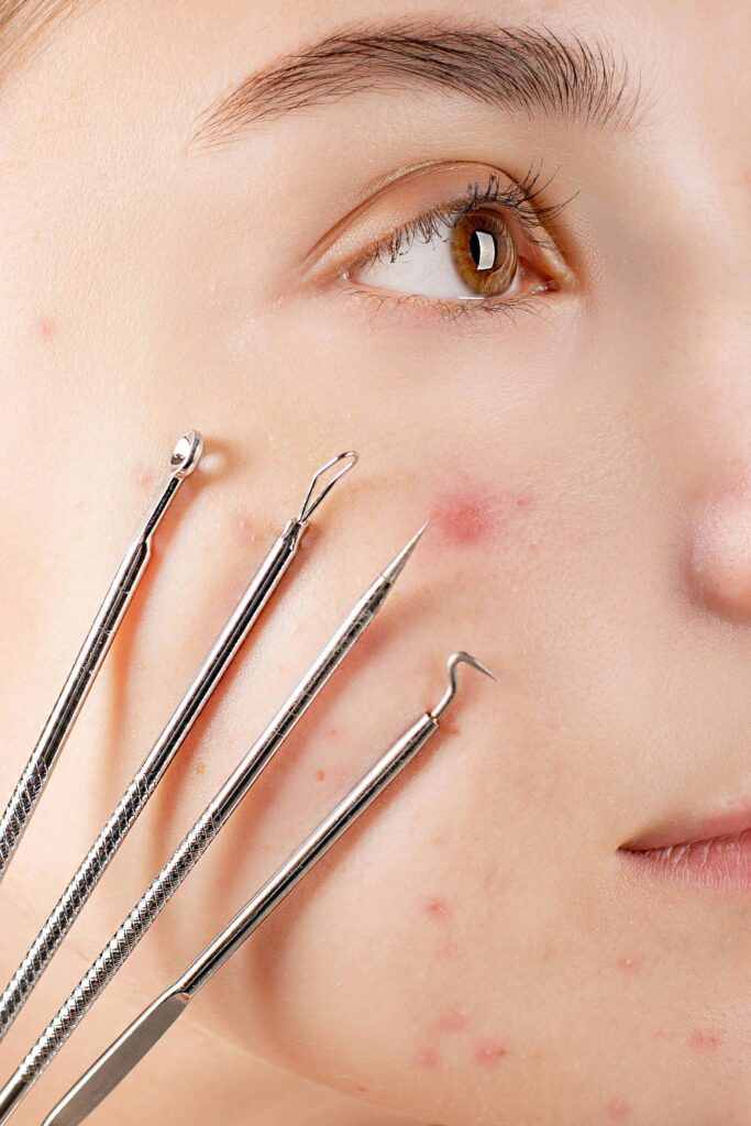 Blackhead & Whitehead Removal
