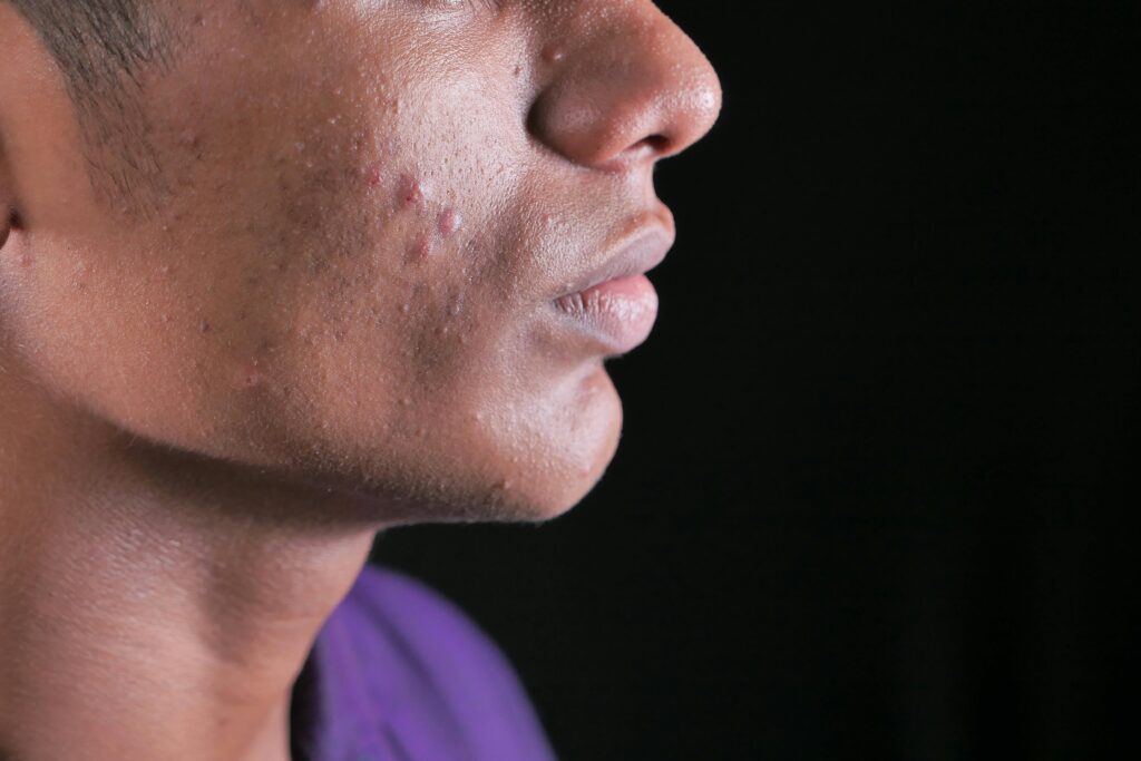 pexels-photo-8589763-8589763 Side view close-up of a young man's face with visible acne on cheek and jawline.